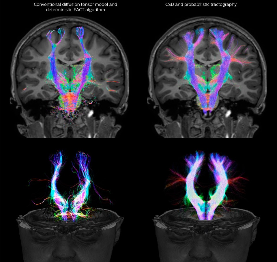 UVM research comparison of fiber tractography methods