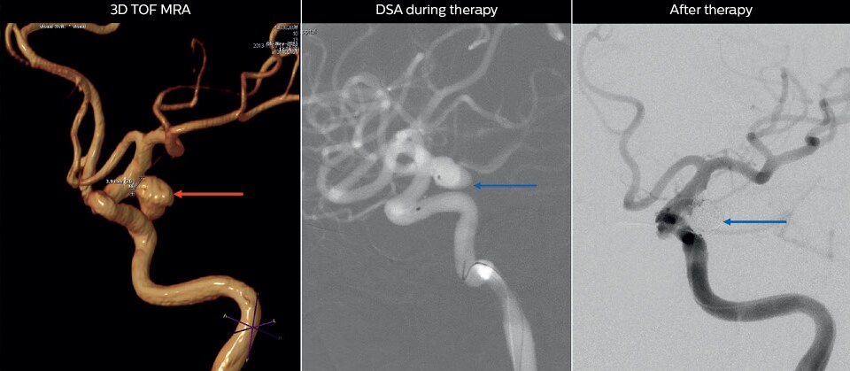 mra of high risk cerebral aneurysm