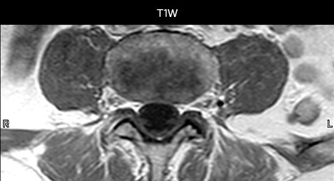 mri in ed back pain tra