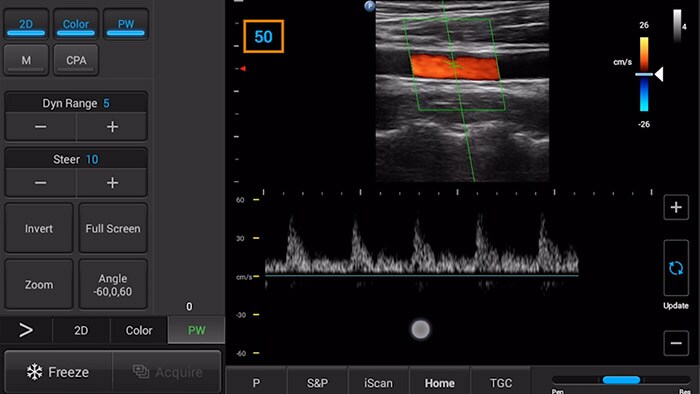 Pulse wave doppler