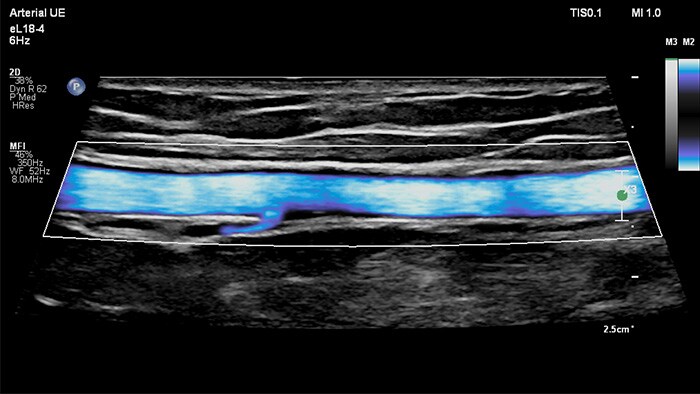 Image with MicroFlow Imaging vascular ultrasound Arterial