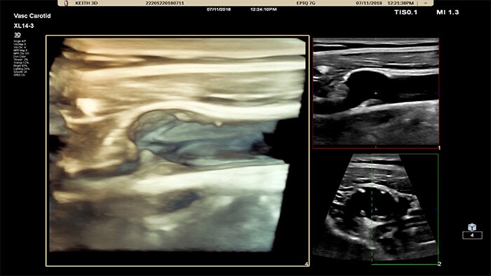 Image retrieved with the easy 3D/4D capabilities of Philips XL14-3 xMATRIX linear array transducer vascular ultrasound
