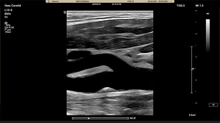 Image with the XRES Pro vascular ultrasound