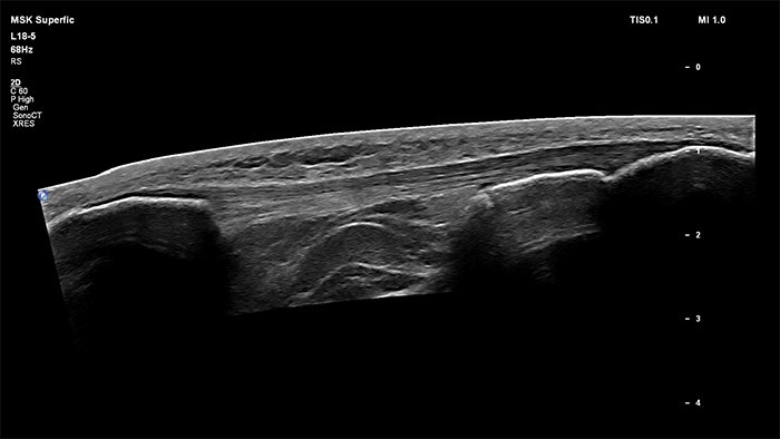 Knee infrapatellar tendon