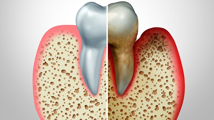 Periodontitis and how to treat it 